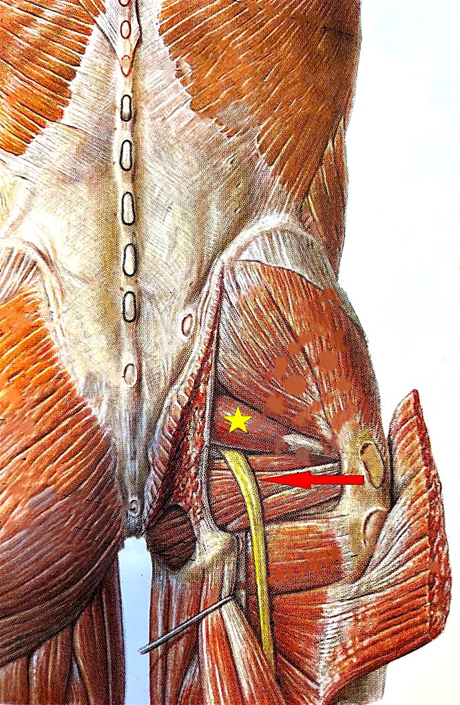 Piriformis Sendromu
